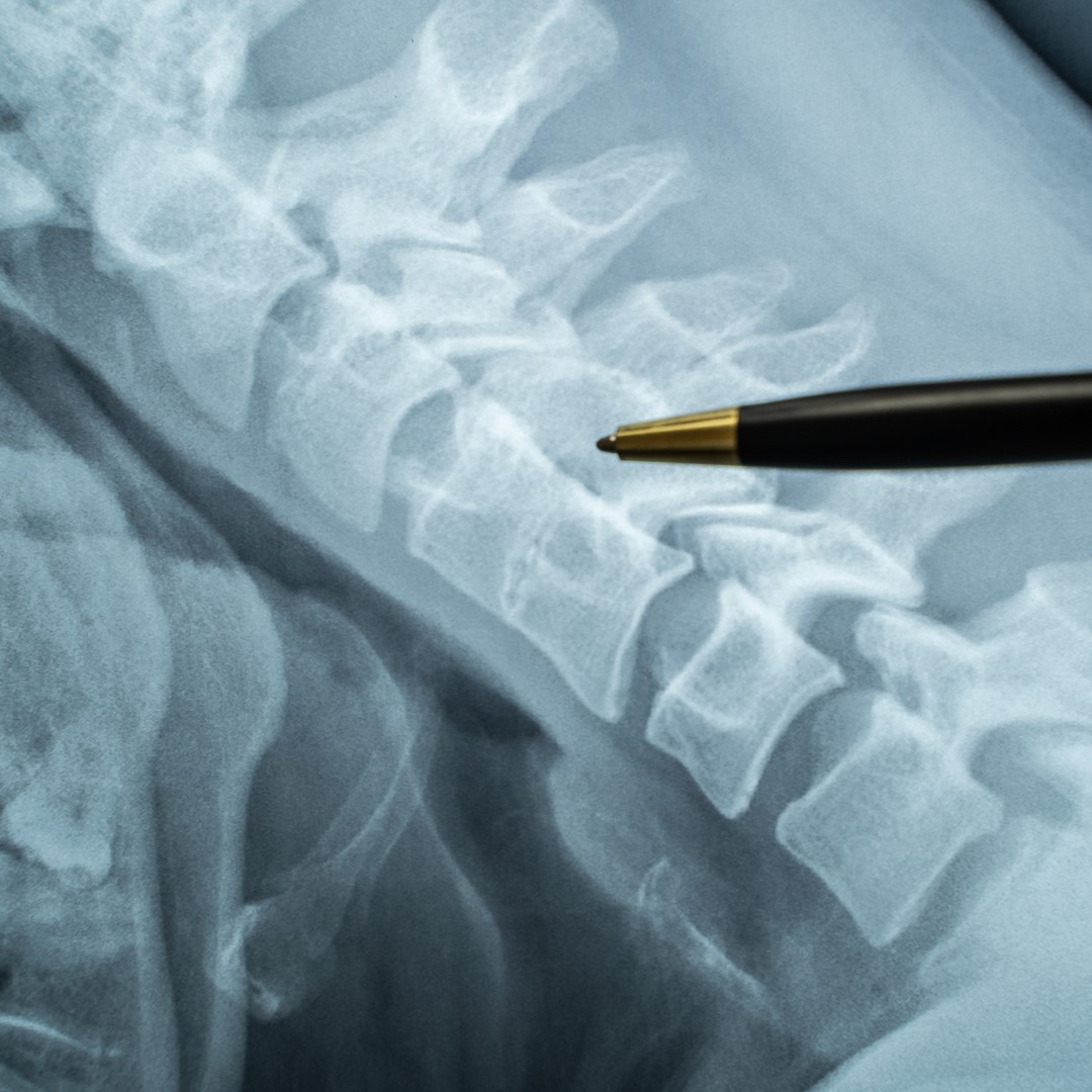 X ray of a spine