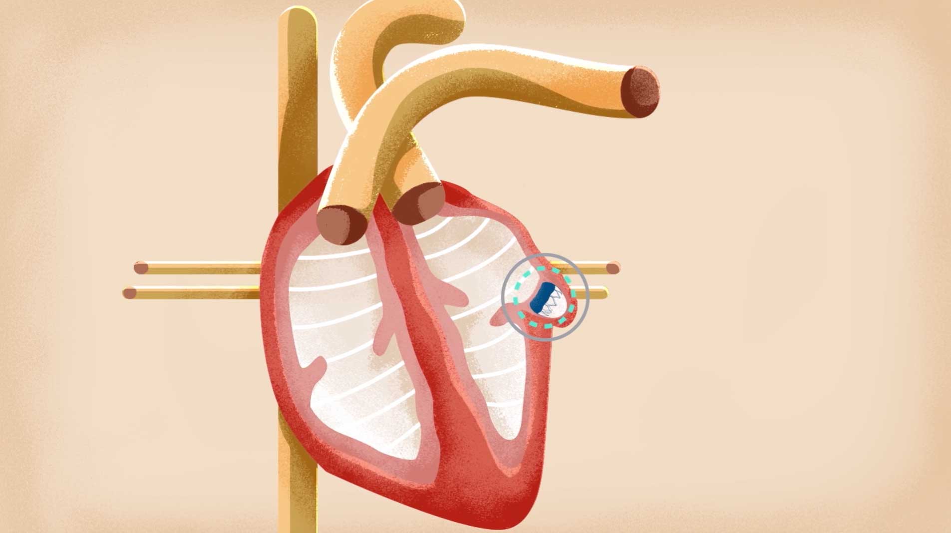 Aultman Performs First Watchman Heart Procedure » Aultman